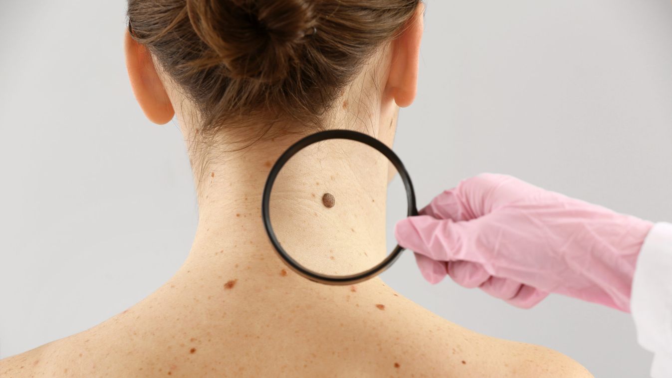 Fontos a korai felismerés! Egyre gyakoribb a melanoma előfordulása Magyarországon