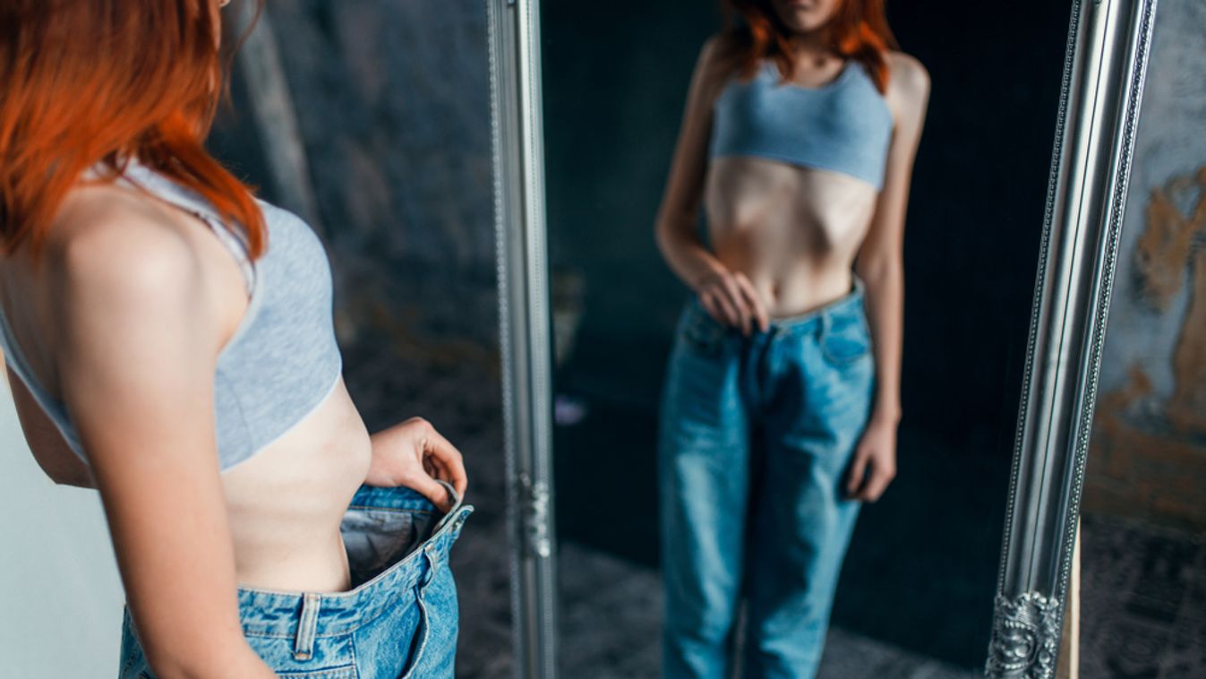 Majdnem belehalt az anorexiába az egyetemista lány, már csak 30 kiló volt