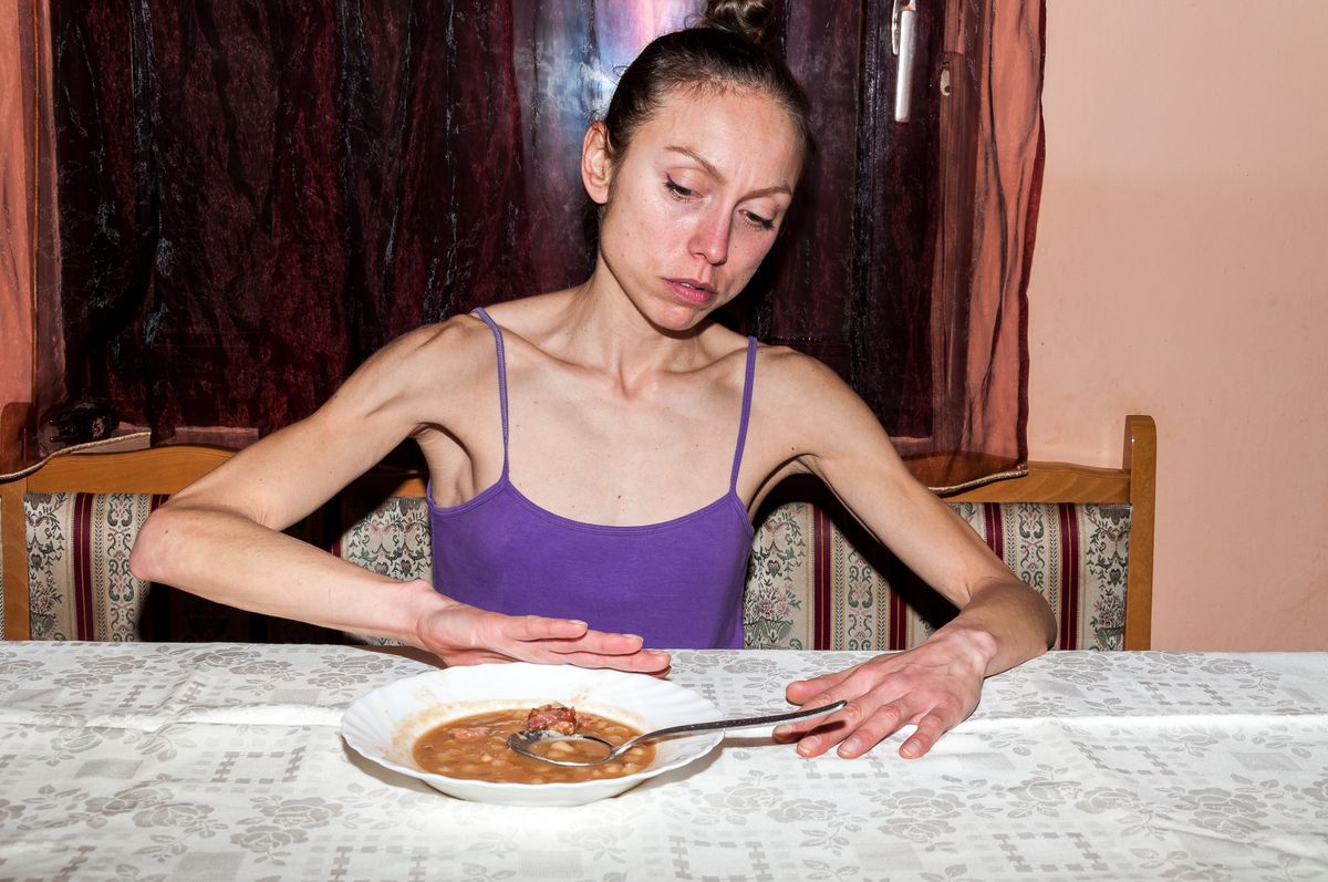 Anorexia nervosa, az életveszélyes evészavar